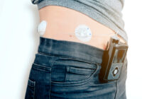close up of a female diabetic patient with infusion insulin pump connected on the belly – medical device with wireless transmission technology – health care concept