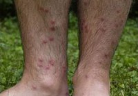 230px-Cercarial_dermatitis_lower_legs