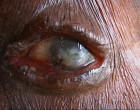 Onchocerciasis-eye