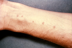 Caption: Rash caused by Schistosome cercaria entering the skin Photo Credit:Content Providers(s): CDC - commons.wikimedia 