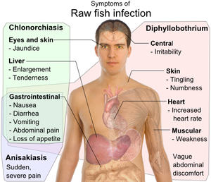 Differential symptoms of parasite infection by raw fish. Source: Wikipedia