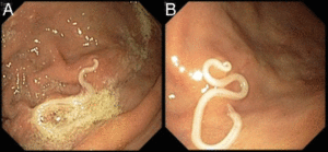 Anisakis firmly attached with its end penetrating the gastric mucosa. From https://0-casereports-bmj-com.brum.beds.ac.uk/content/2017/bcr-2016-218857.full
