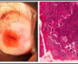 Figure 2. Hand-held colposcopic image with FGS areas highlighted (left). Histopathology section of one of the FGS lesions showing S.haematobium eggs (right).