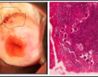 Figure 2. Hand-held colposcopic image with FGS areas highlighted (left). Histopathology section of one of the FGS lesions showing S.haematobium eggs (right).