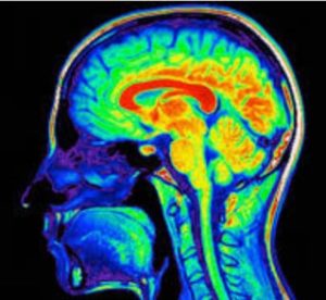 Encephalitis brain image